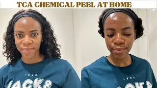 10% TCA CHEMICAL PEEL AT HOME | FULL PROCESS | ACNE SCARS + HYPERPIGMENTATION.