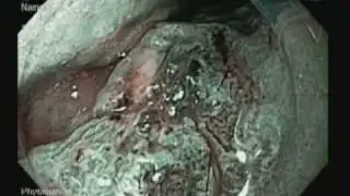 Endoscopic mucosal resection/Barrett's esophagus