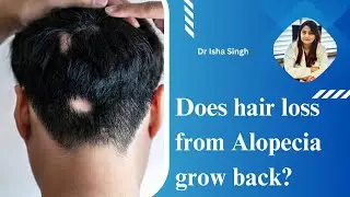 What is Alopecia areata ?- Causes, Diagnosis & Hair Re-growth | Patient education I MIC