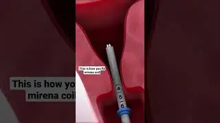This was how your Mirena coil was fitted 