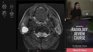 Bilateral Parotid Diseases - Radiology Review Course (MRI, CT, ultrasound)