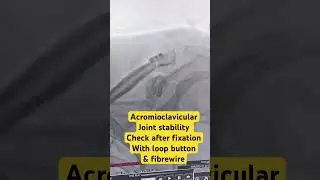 AC joint injury & fixation with loop button & fibrewire #shoulder #injury #ligaments #sportsinjury