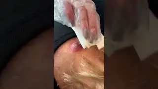 Black head removal on face - Blackheads on back treatment