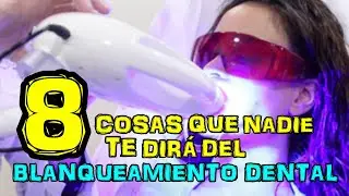 8 Cosas que nadie te dirá del blanqueamiento dental   Dr Rod