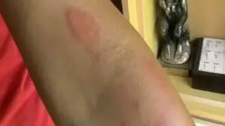 Histaminic reaction across the lymph vessels on patient's forearm