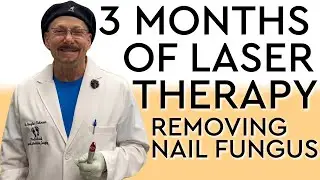 3 Months of Laser Therapy Removing Nail Fungus