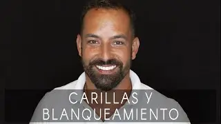 La sonrisa de Tiago: carillas y blanqueamiento dental