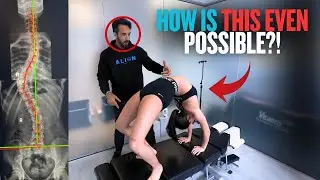 Extreme Chiropractic Adjustment for Teen Dancer With Scoliosis