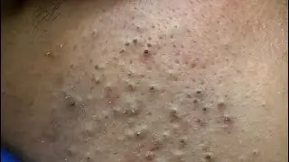 Satisfying Deep Blackhead Removal on Nose | Korean Skincare Routine