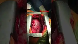 An intraoperative look at a stab wound of the chest.