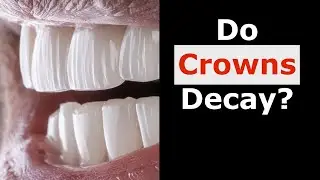 Do Crowns Decay?
