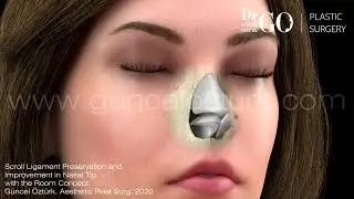 Nasen Let Down & Push Down Preservation Rhinoplasty Operation - Assoc.Prof.Dr. Guncel Ozturk 