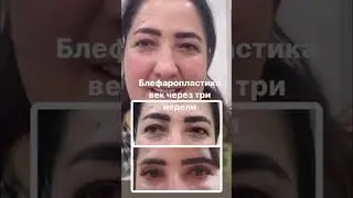 Блефаропластика верхних и нижних век по акции ташкент +998998850724