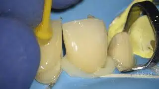 Zirconia Veneers and Crowns Under a Dental Microscope