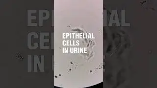 Epithelial cells in urine under the microscope 