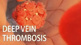 Venous thromboembolism | Deep vein thrombosis (DVT)  | medical animation