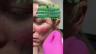 Add Volume to the Cheeks with Dermal Filler