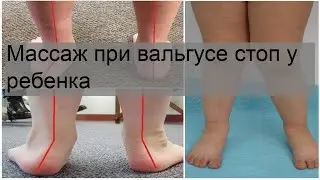 Массаж при вальгусе стоп у ребенка