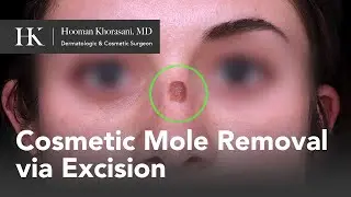 How to remove a mole on the nose with cosmetic surgery | Dr. Hooman Khorasani | NYC