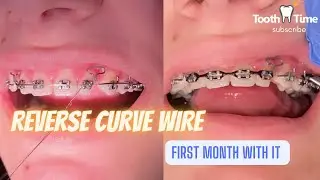 What does a reverse curve wire do for braces? 1 Month Check Up - Tooth Time Family Dentistry