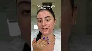 Your Teenage Acne Might Not Go Away 