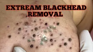Heavy Blackhead Removal ASMR.