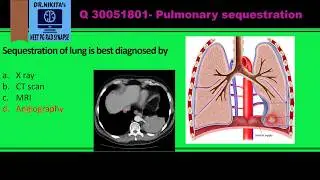 Pulmonary sequestration