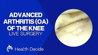 Advanced Arthritis (OA) of the Knee - Arthroscopic Surgery