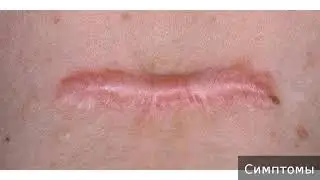 Келоидный рубец  Как лечить келоидный рубец