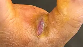 Injury ball