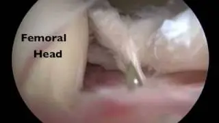 Hip Arthroscopy Capsulotomy