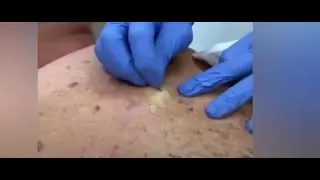 Pimple Popping Compilation | Huge Cyst Extraction and More