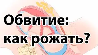 Обвитие пуповиной: как рожать? | Естественные роды при обвитии пуповиной | 