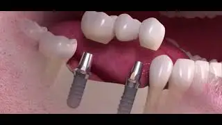 Le BRIDGE sur IMPLANTS dentaires - le pont dentaire sur implants