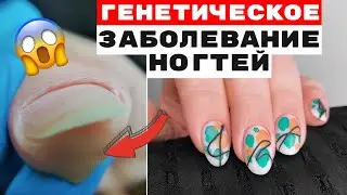 Генетическая болезнь ногтей😱 Исправление формы ногтей