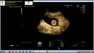 Normal Fetal Screening in the First Trimester at 14 Weeks (Dr. Wiku Andonotopo)