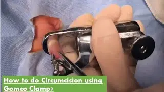 Circumcision using Gomco Clamp