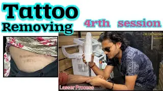 How to Remove tattoos || 4rth session tattoos removal process #tattoo #removal #tutorial #stepbystep