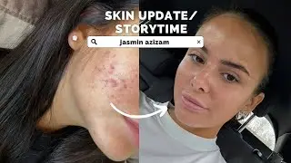 VLOG: Skintalk, Erfahrung mit der Pille, Hormonelle Akne .. - Jasmin Azizam