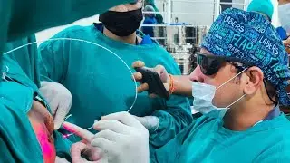 FISTULA-IN-ANO| DLPL |KSHARA SUTRA LIGATION| #fistulatreatment #patanjali  #india