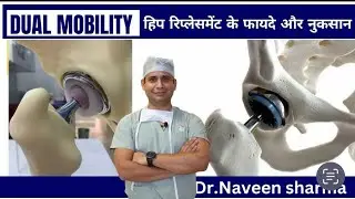 Dual mobility ka fayda aur nuksan kya hoga ? / mere liye kya accha hai ?
