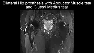 Bilateral Hip prosthesis with Abductor Muscle tear and Gluteal Medius tear