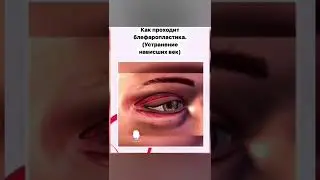 Как проходит блефаропластика. Устранение нависшего века.