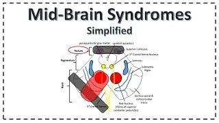 Mid-Brain Syndromes | Weber Syndrome | Benedikt Syndrome | Parinaud's Syndrome