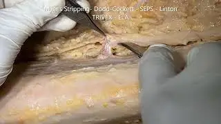 SAPHENOUS Vein Nerve CRURAL Fascia PES ANSERINUS and Clinical Aspects – Sanjoy Sanyal