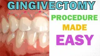 GINGIVECTOMY - PROCEDURE EXPLAINED IN 5 MINUTES - INDICATIONS, INSTRUMENTS, PROTOCOL, AFTER CARE