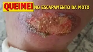 Queimadura com escapamento de moto IMAGENS FORTES