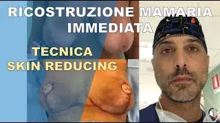 RICOSTRUZIONE MAMMARIA IMMEDIATA bilaterale - Tecnica SKIN REDUCING MODIFICATA