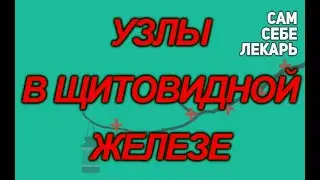 Не Будьте Злы На Узлы Щитовидной Железы Или Как Лечить Щитовидку