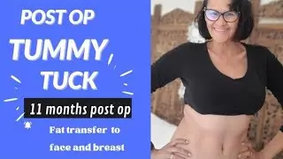 Post Op Tummy Tuck Journey/11 months Post op  Scar and Tummy update/Pearl Signorile vlogs
